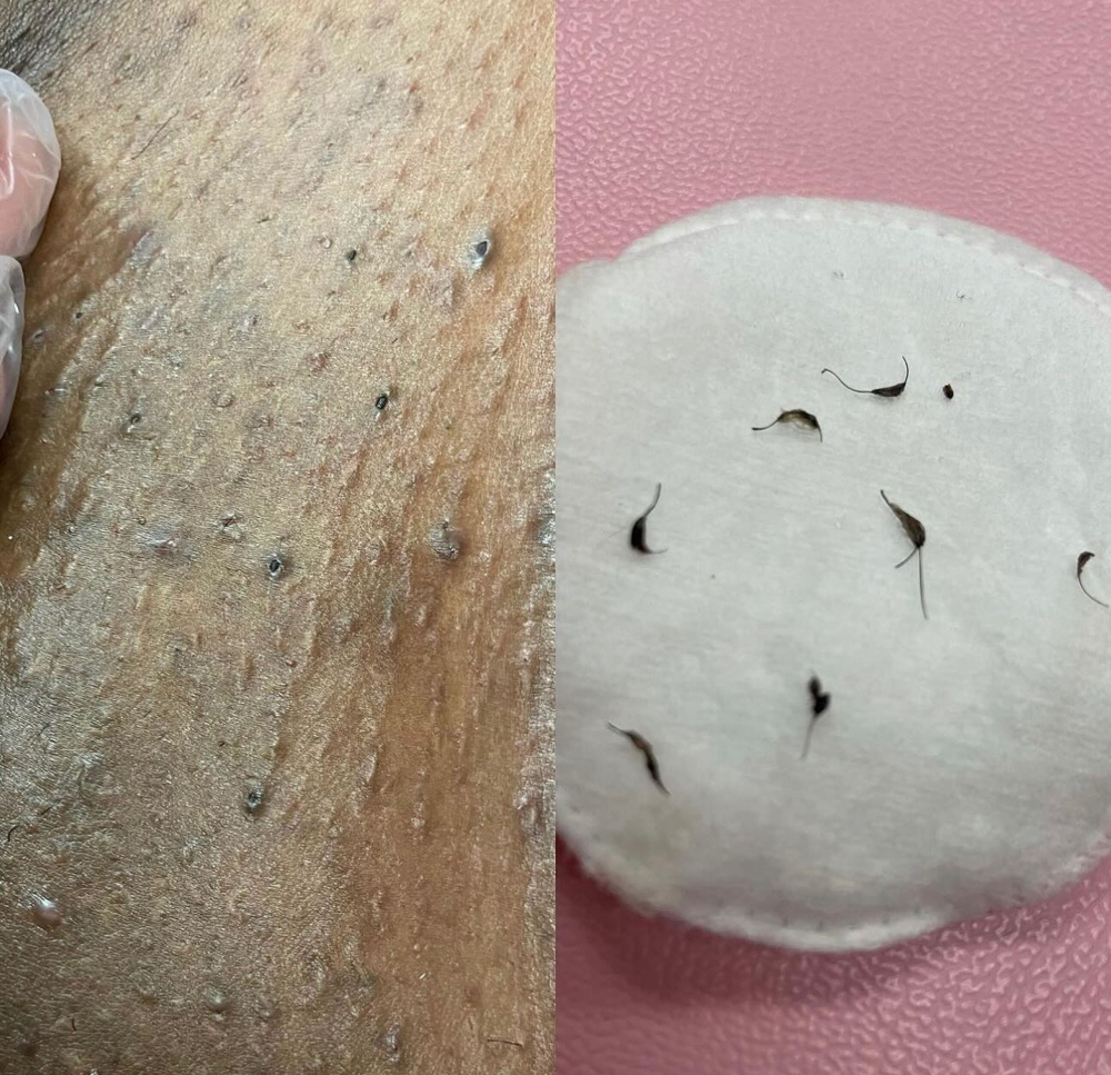 Post-Wax Extractions (Add-on)