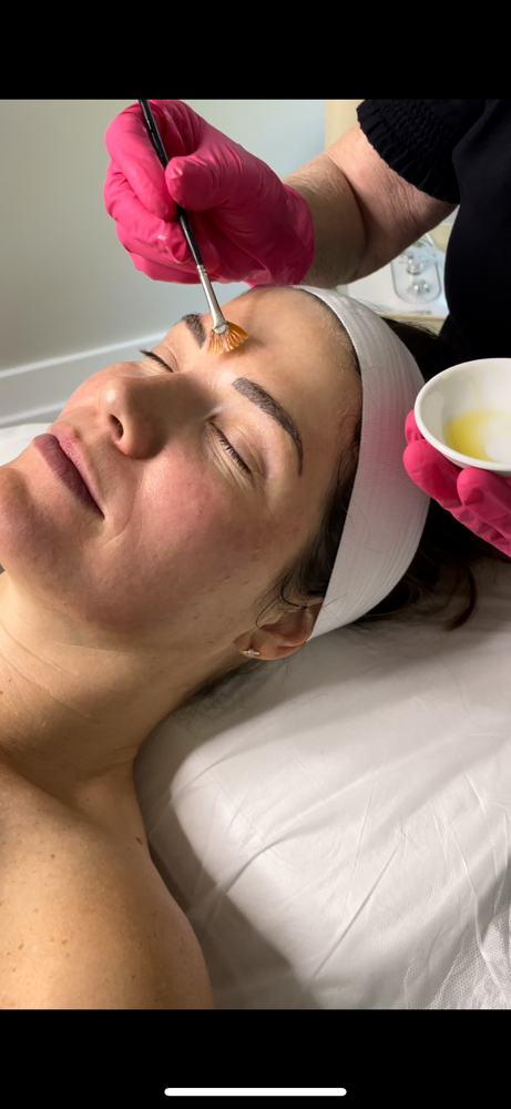 Mid Depth Peel (50 mins)