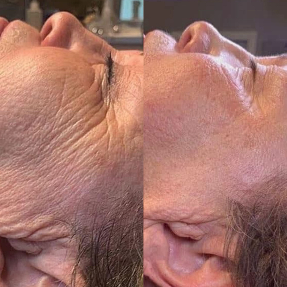 Microchanneling Therapy at Blu Topaz Esthetics in Aurora, IL