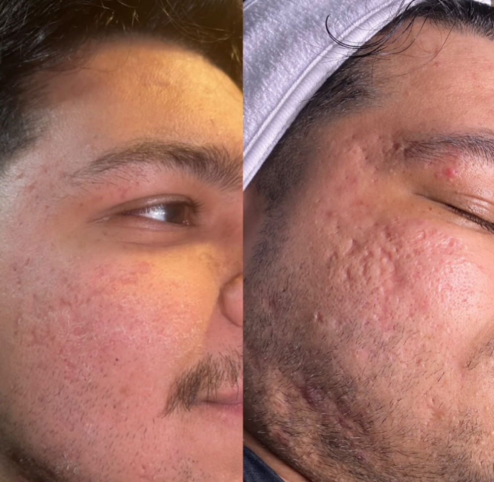 Microchanneling Facial