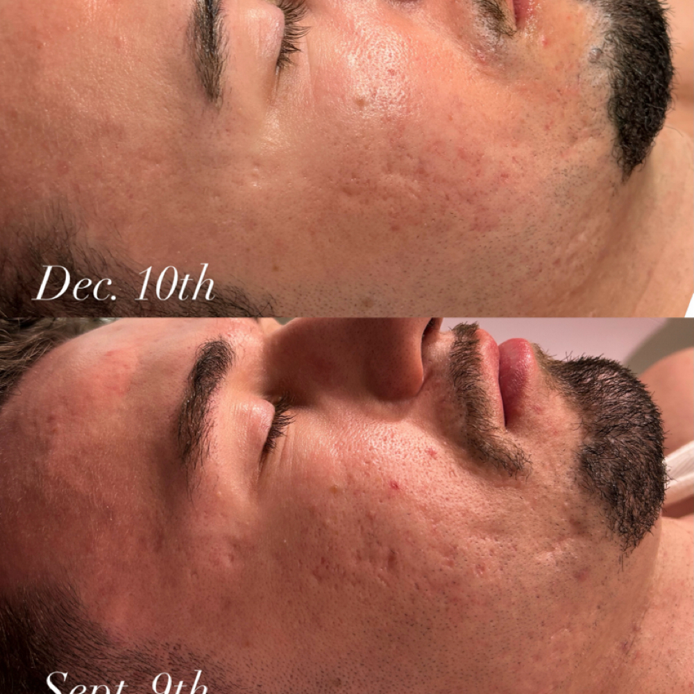 Microchanneling Facial at Blu Topaz Esthetics in Aurora, IL