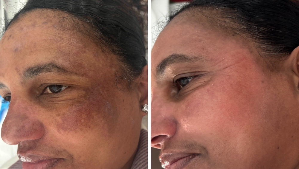 Dermamelan Peel(Introductory Price)