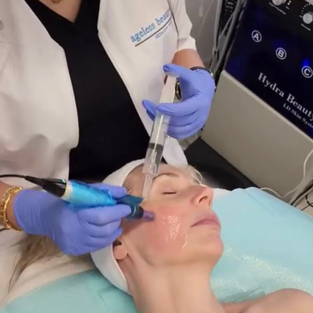 limited time only / Microneedling at Ageless Beauty Skincare Clinic in Sterling, VA