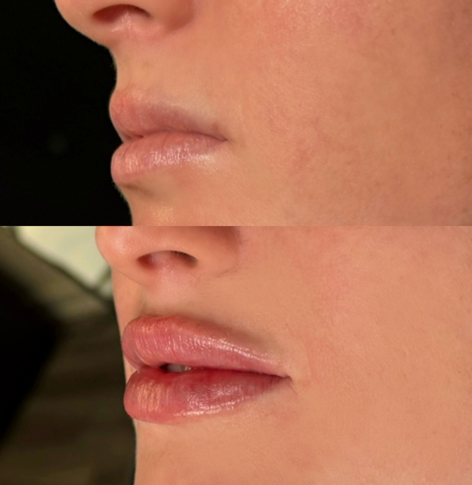 Lip Filler - Half Syringe