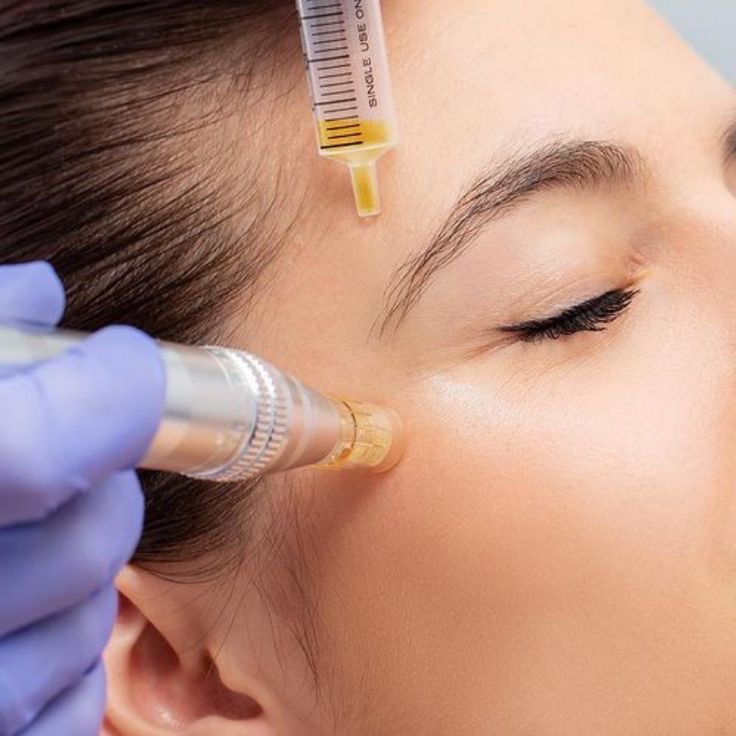 Microneedling Facial  With Vitamins