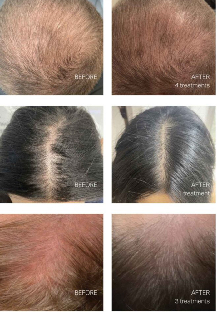 Hydrafacial Keravive