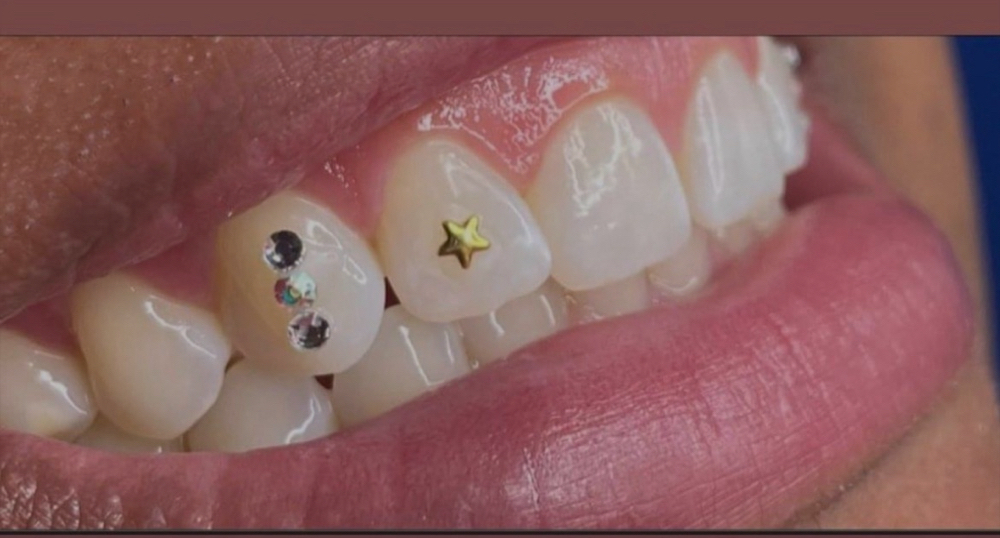 Tooth Gems