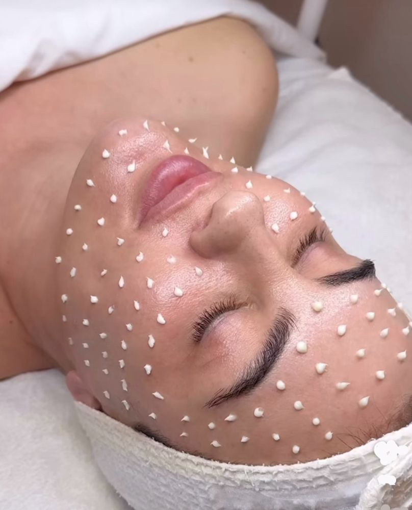 LIQUID Microneedling