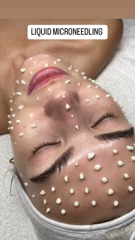LIQUID Microneedling