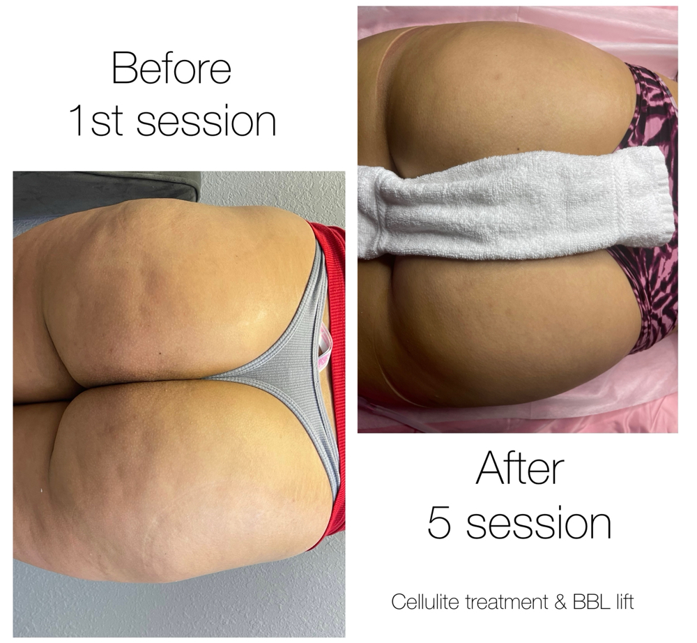 Cellulite treatment