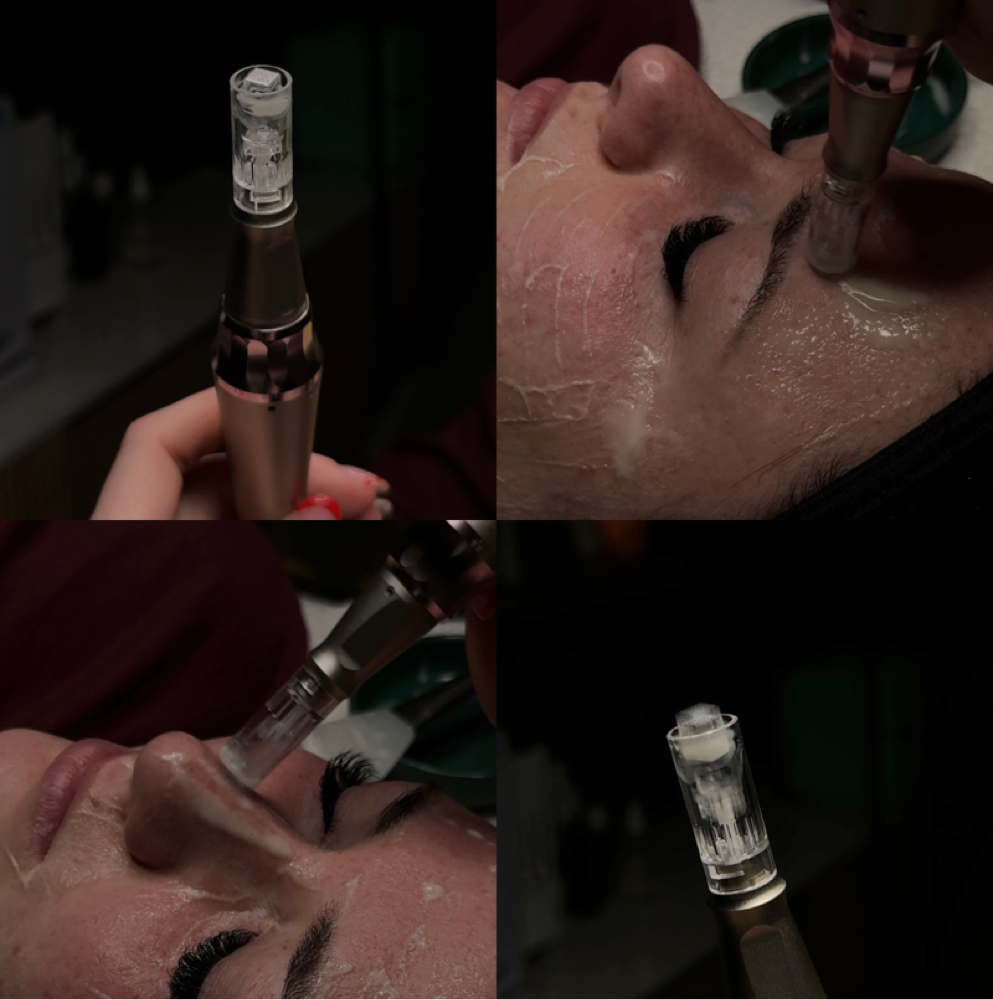 Nano-Infusion Add On at Mountain High Esthetics in Billings, MT