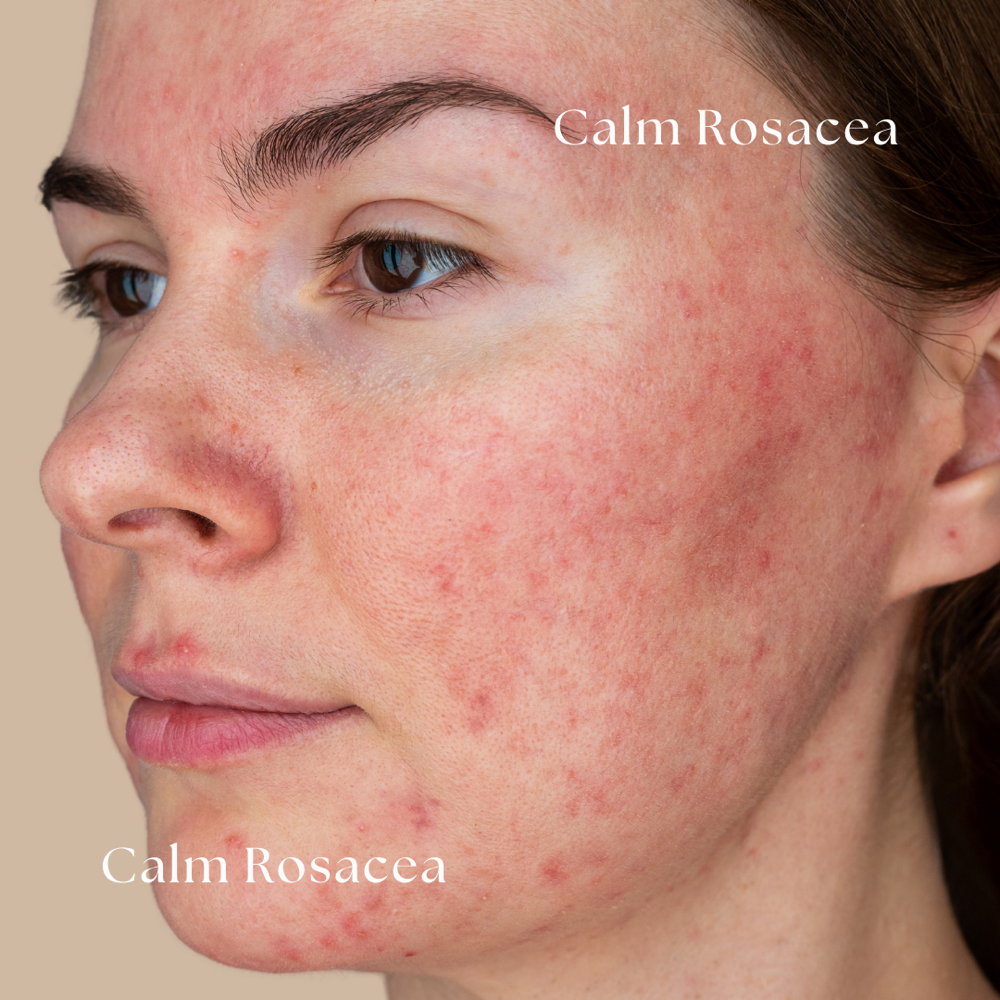Calm Rosacea