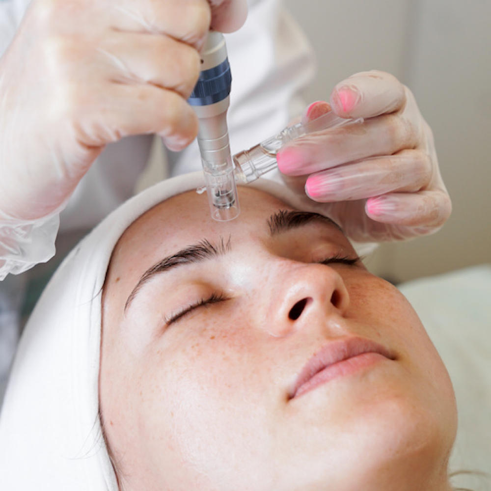 MICRONEEDLING (2 sessions) at Belle Vie Esthetics by Andreia Miranda in Natick, MA