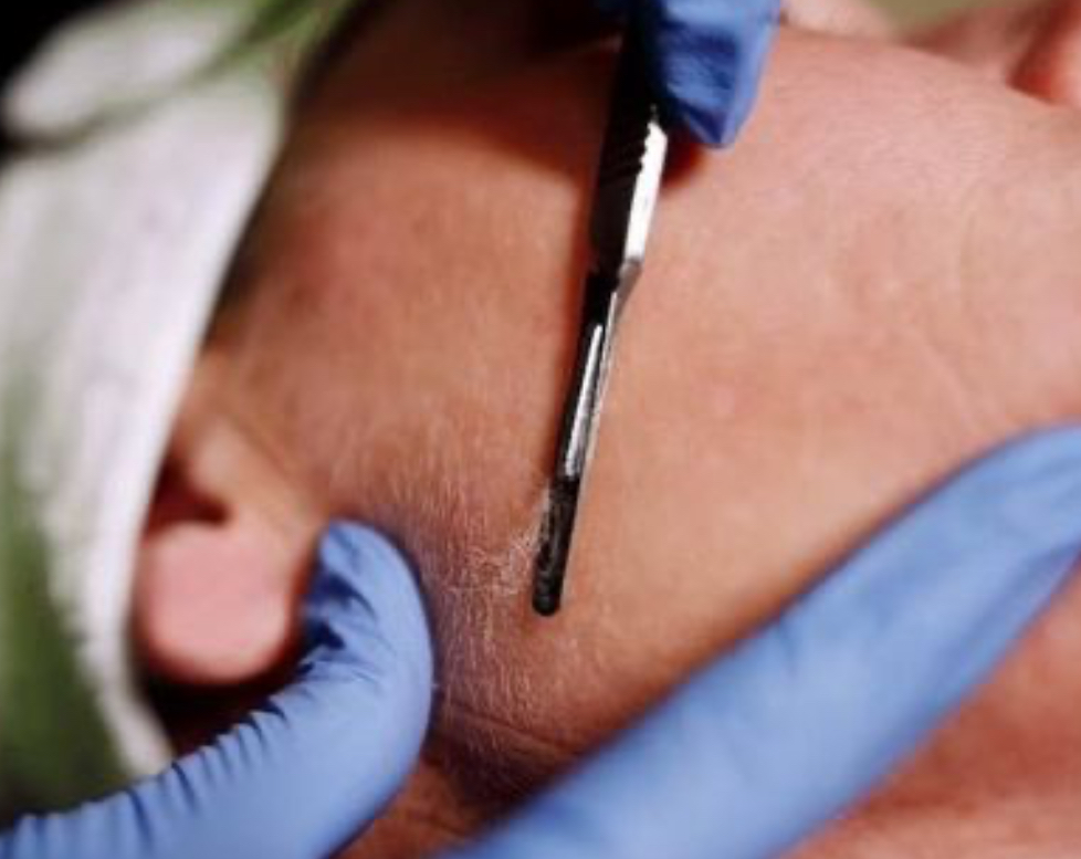 Derma-planing Facial