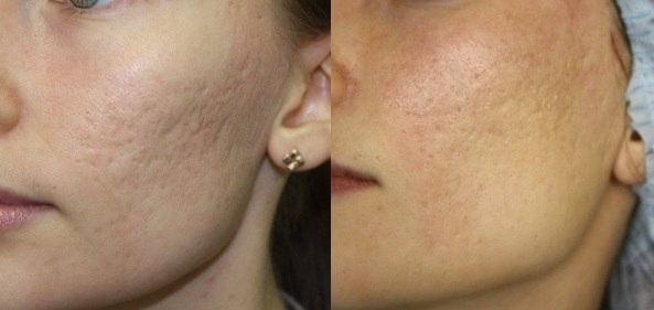 MickroNeedling Face Cell ID