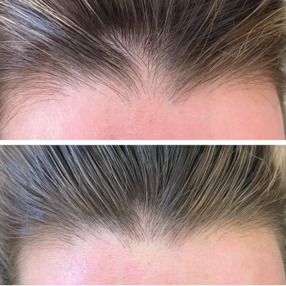 Scalp Microblading