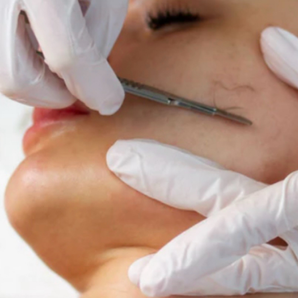 Dermaplaning at Paris Beaute in Fresno, CA