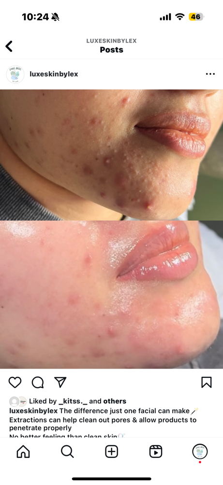 Acne Detox