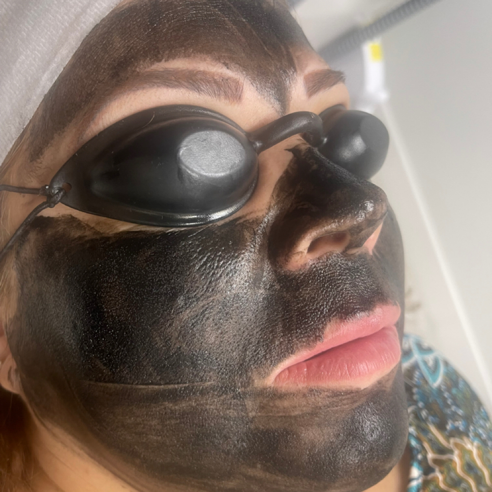 CARBON LASER FACIAL at Zentique Aesthetics in Las Vegas, NV