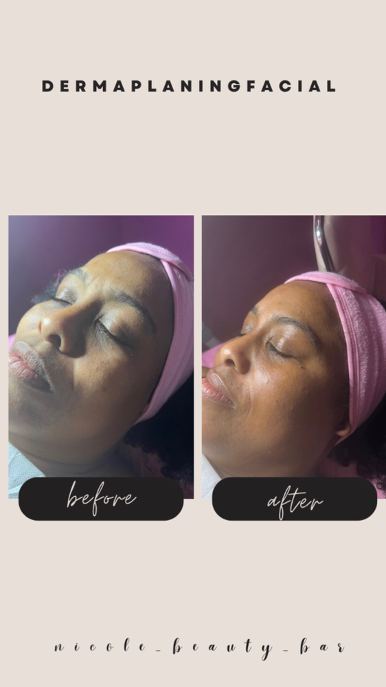 Dermaplaning