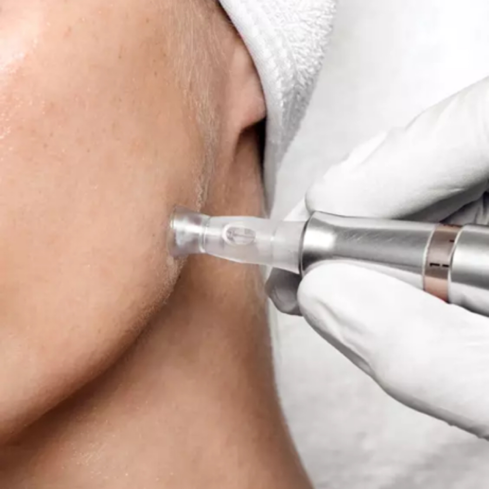 Microneedling (dermapen) at Glow skin aesthetics in Addison, TX