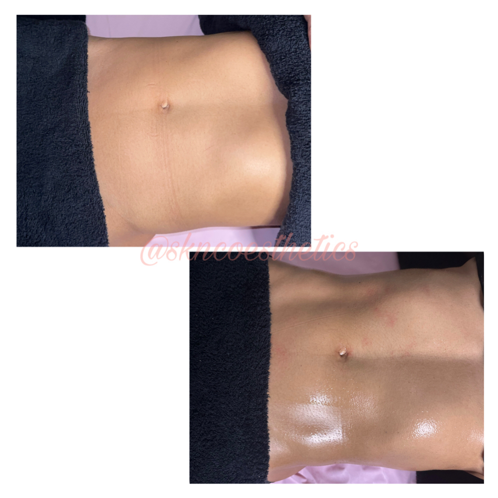 Abdomen And Sides at SKN Co. Esthetics in Brewster, NY