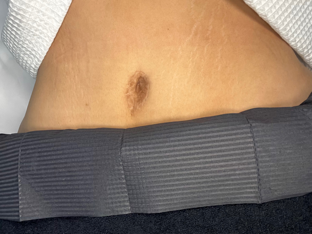 Belly Button Microneedling