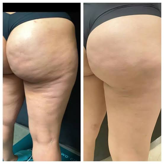 Cellulite Reduction Treatment