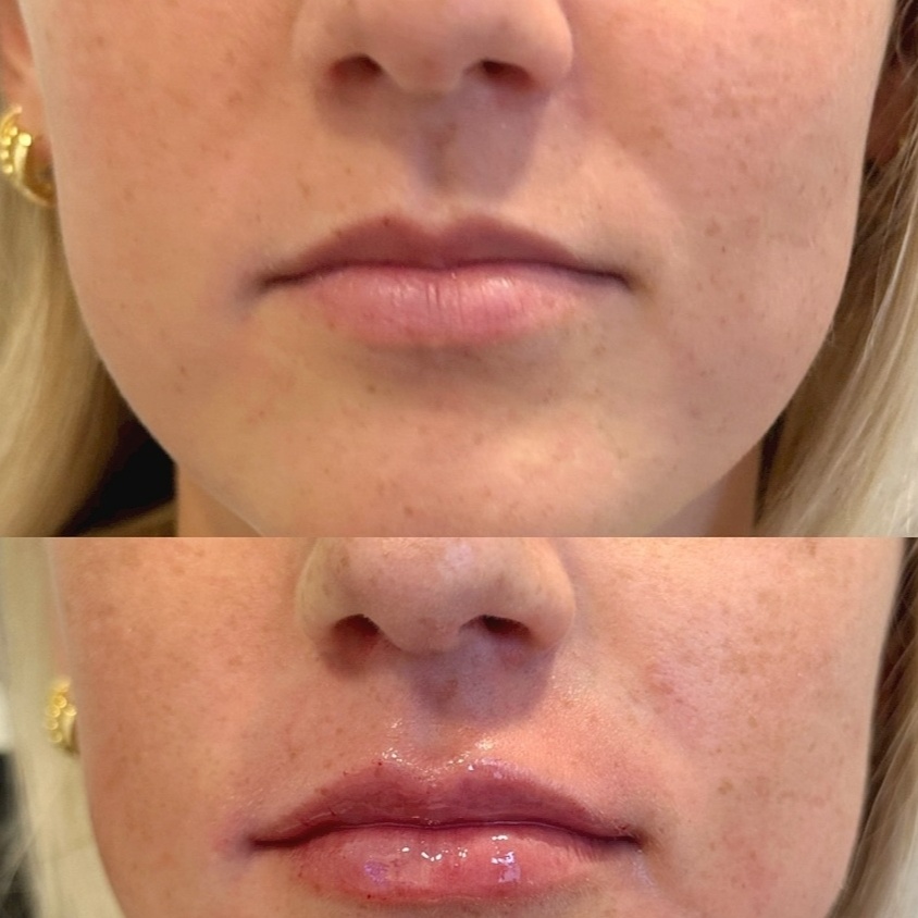 Baby Lip Filler at Skin & Toxx in Houston, TX