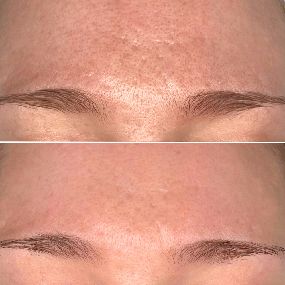 FactorFive Peel W/ Microneedling