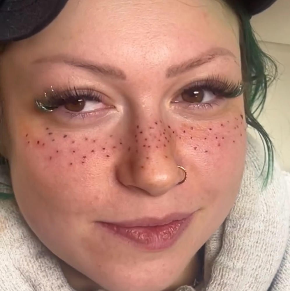 Freckles