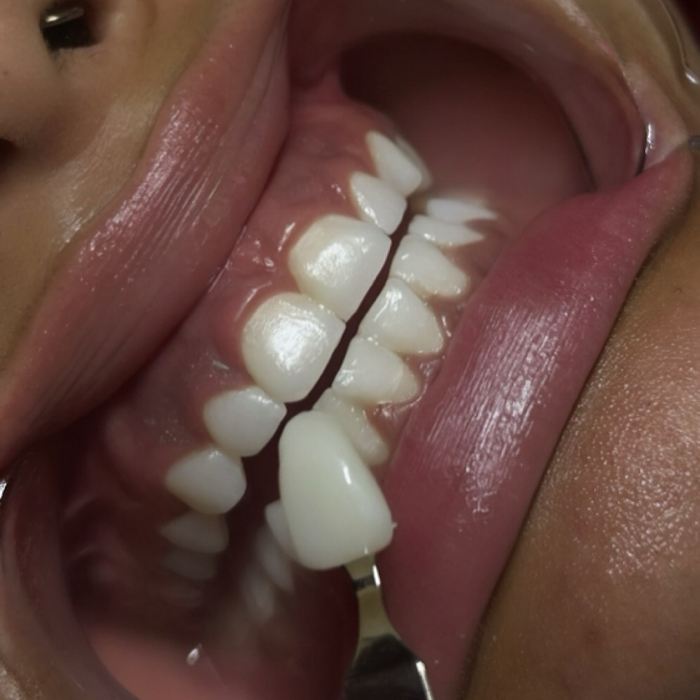 teeth whitening session at millionaireminks in Houston, TX