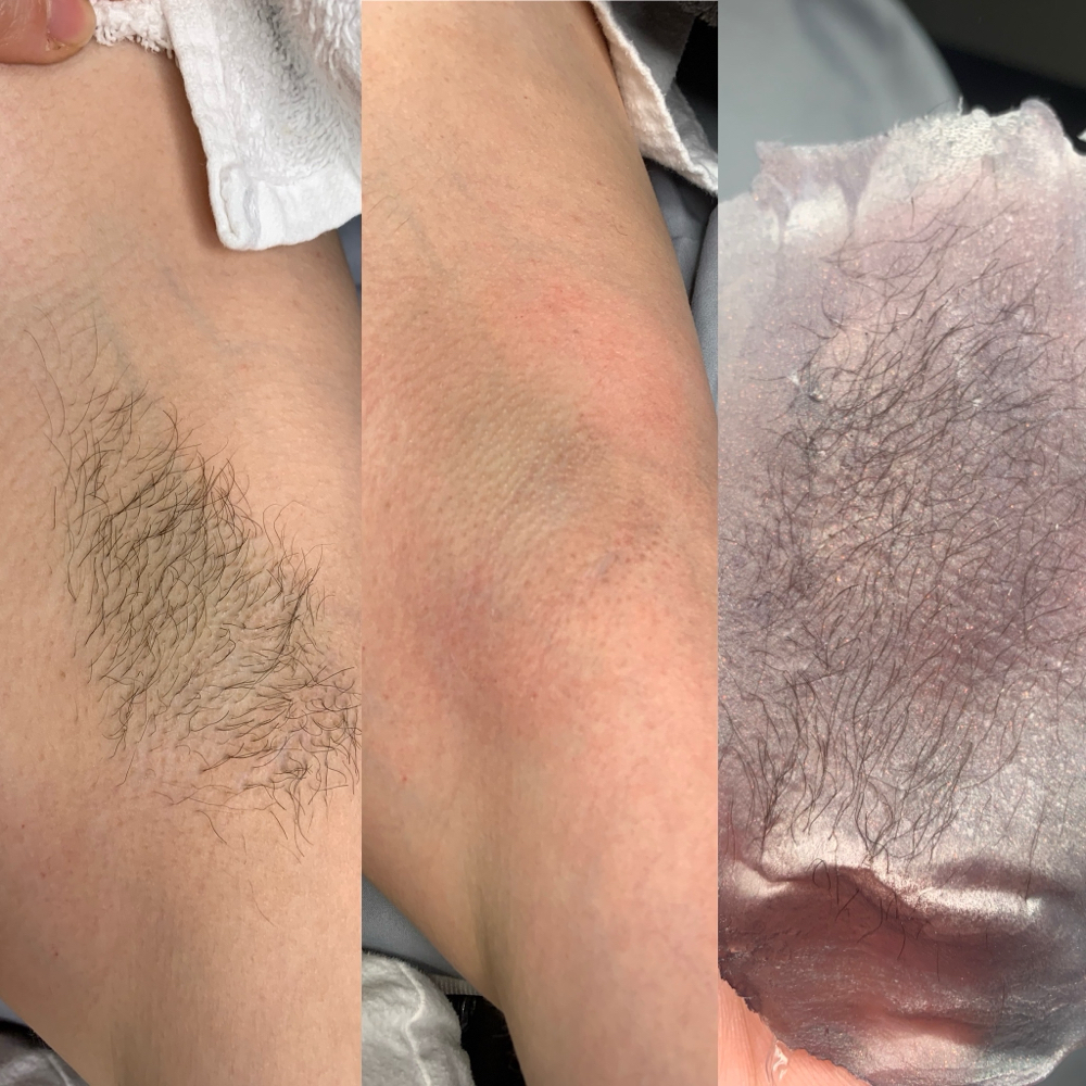 Underarms at Raine Esthetics in Pendleton, IN