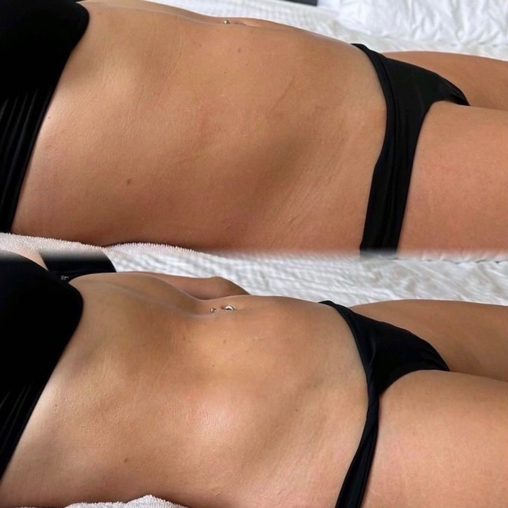 Brazilian Lymphatic Belly Detox at Glam Muse Aesthetics in Garden City, NY