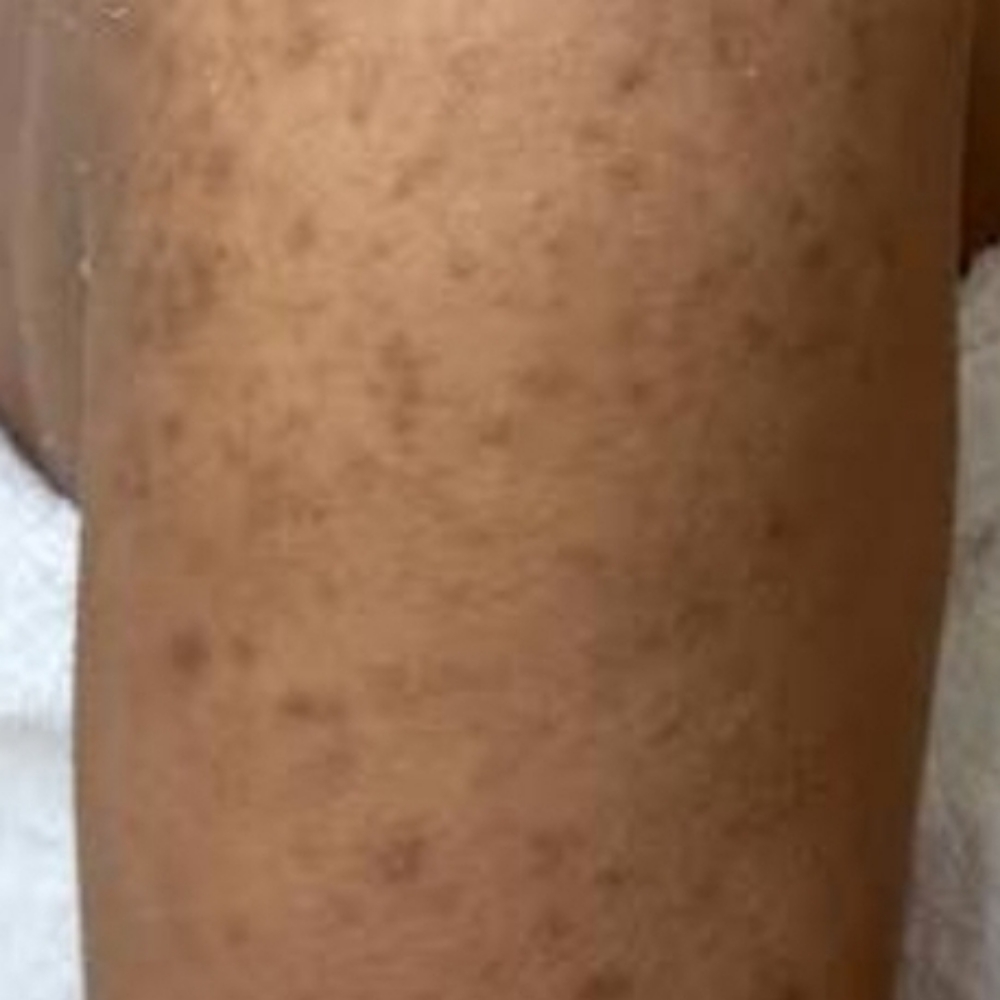 Arm Chemical Peel at Basic and Beyond Brows in Lakewood, CA