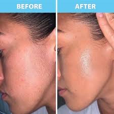 Peach Fuzz Removal