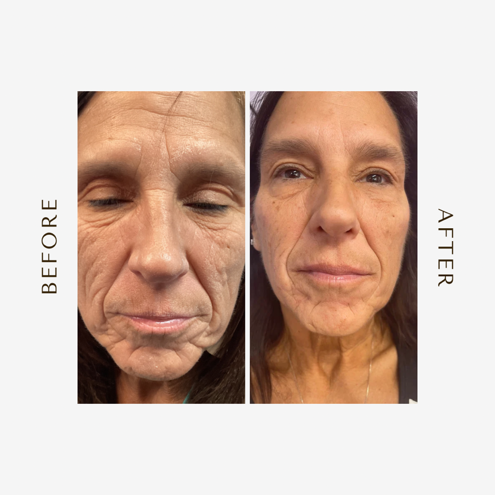 Hyaluronic Acid Filler Injection