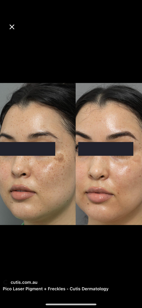 Pigmentation Treatments