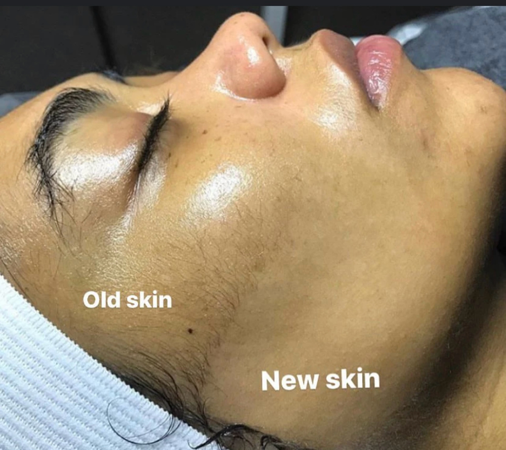 Dermaplane Facial Package