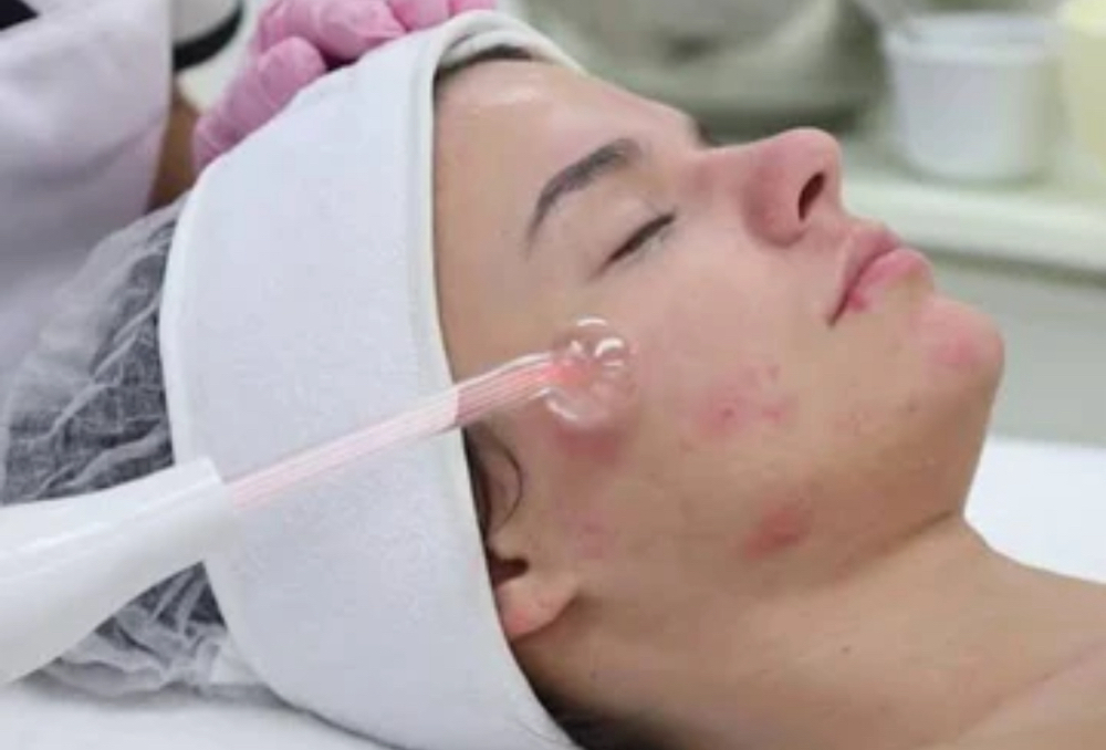 Teen Acne Facial