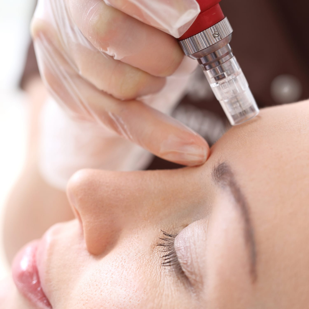 Microneedling Facial