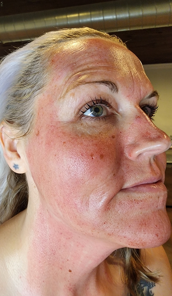 Microneedling x1: Face Only