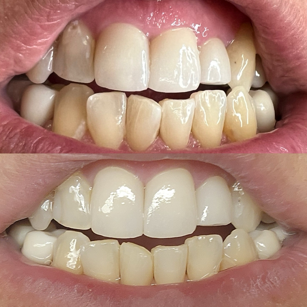40 Min Teeth Whitening Session