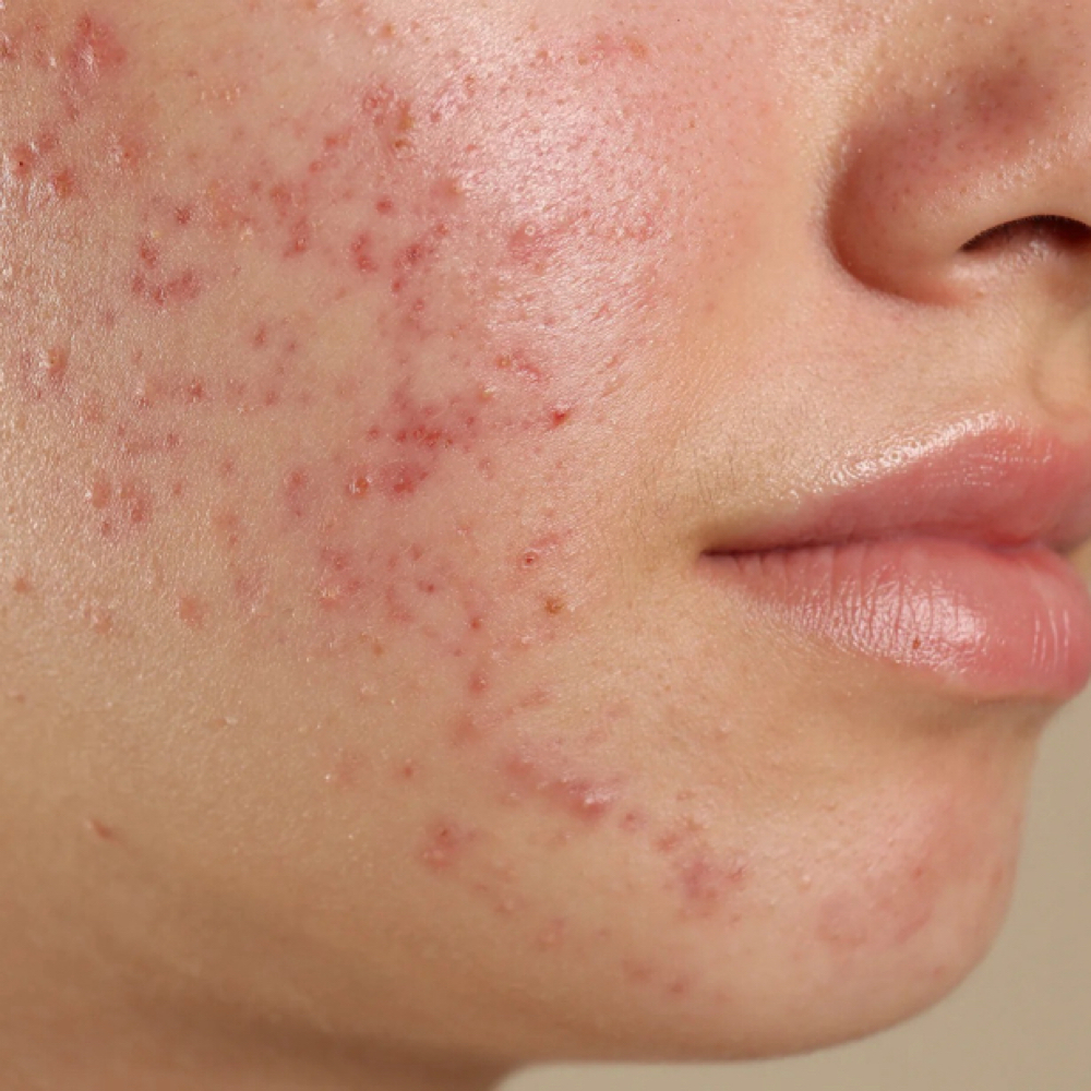 Clear Skin Elite at Michelle Marie Clinical in Temecula, CA