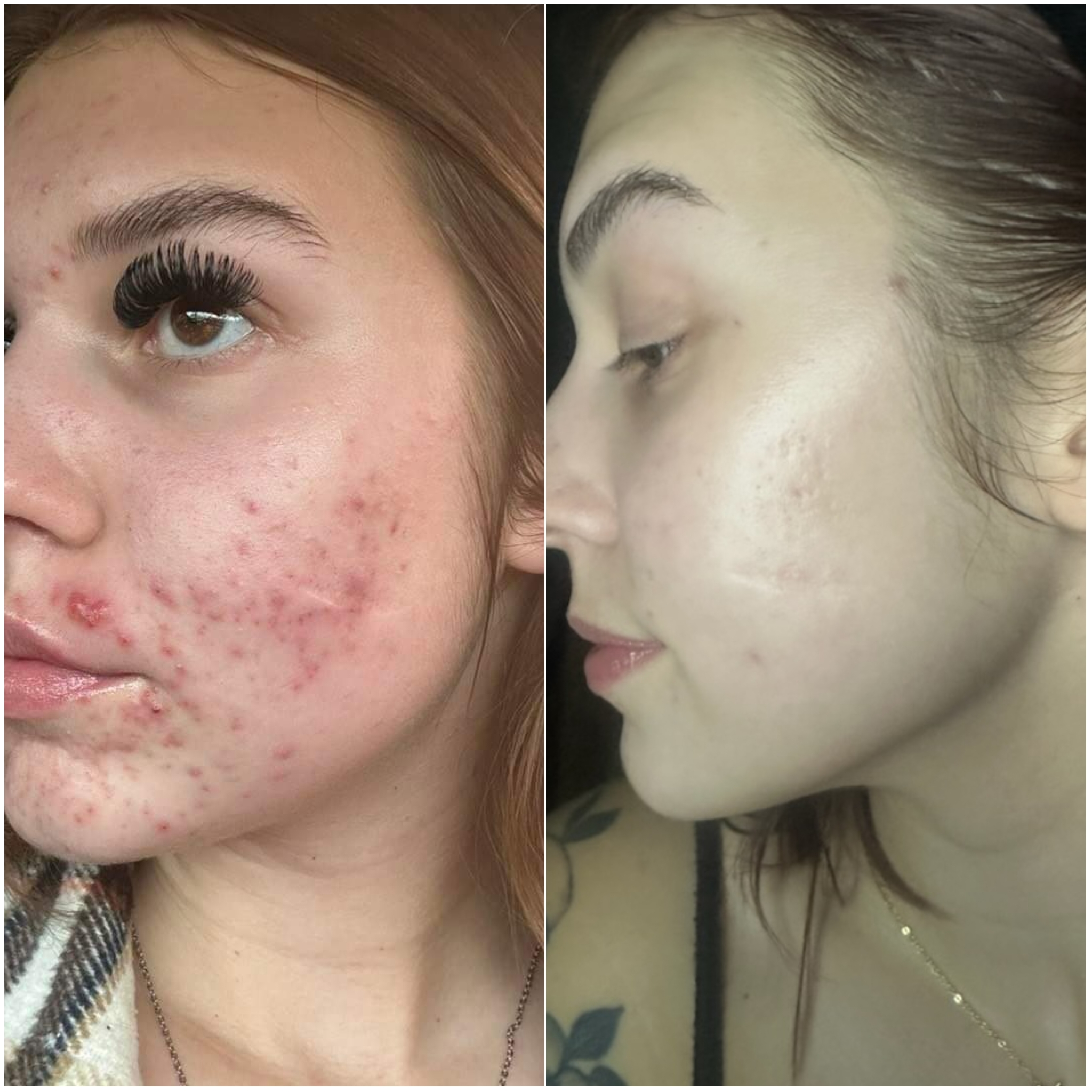 Acne Clearing Facial