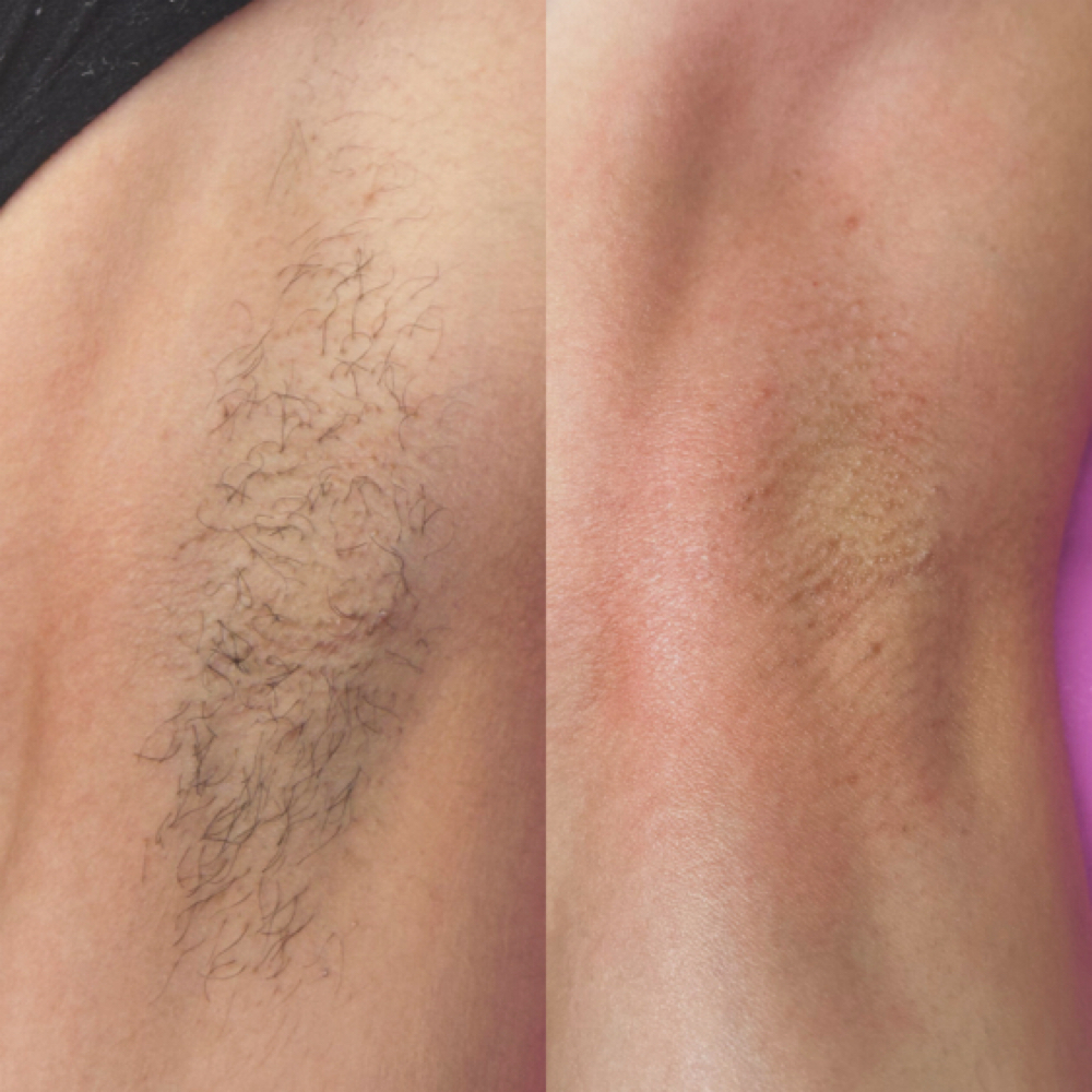 Armpit Wax at Mel Esthetics LLC in Denver City, TX