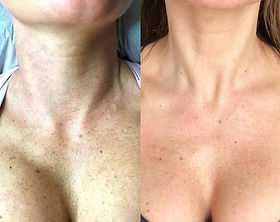 Procell Face-Neck-Chest