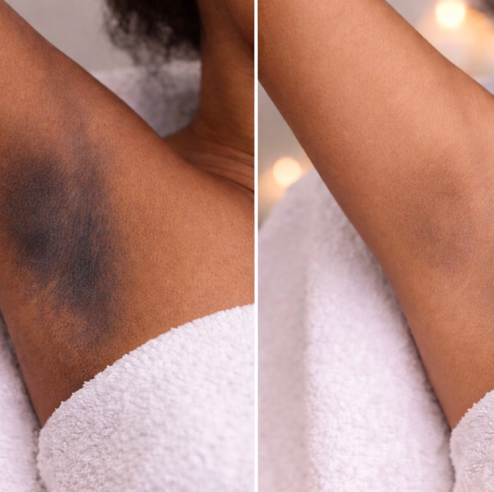 EvenTone Intimate Brightening at GlorgeousSkinn Aesthetics in Houston, TX