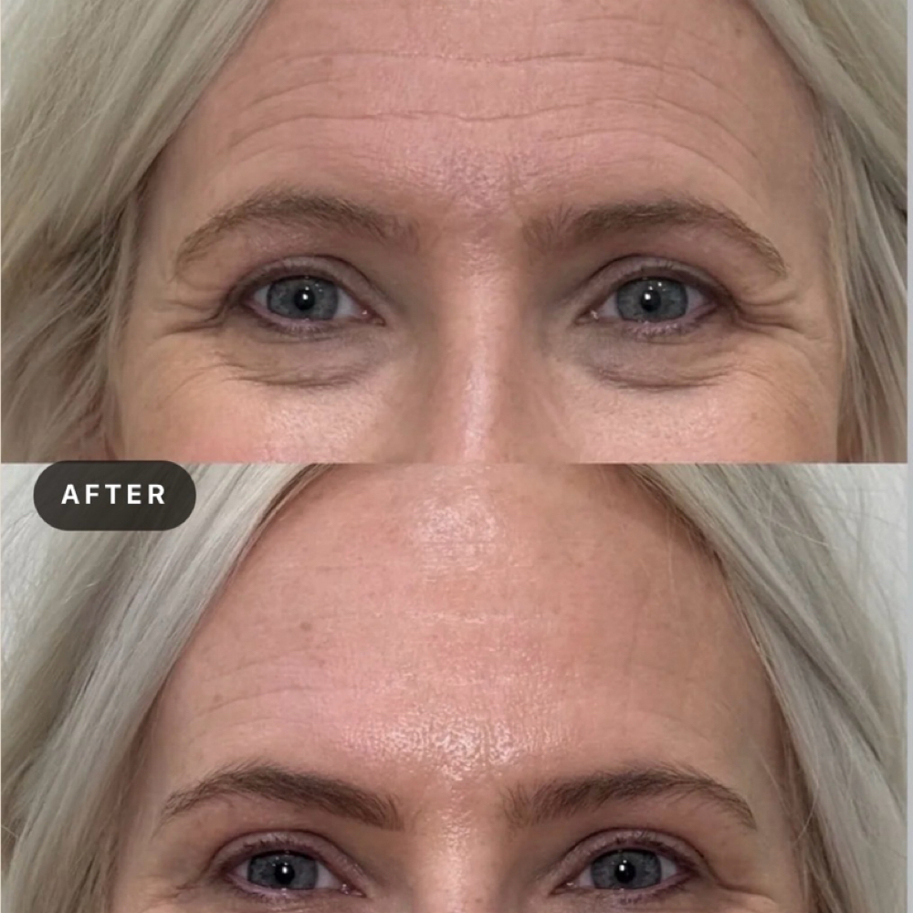 Botox at Alchemy Aesthetics + MedSpa in Overland Park, KS