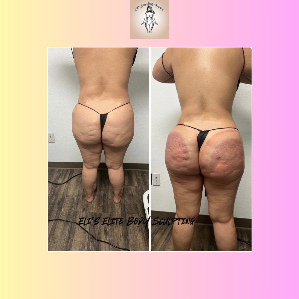 BBL Vacuum with back lipo